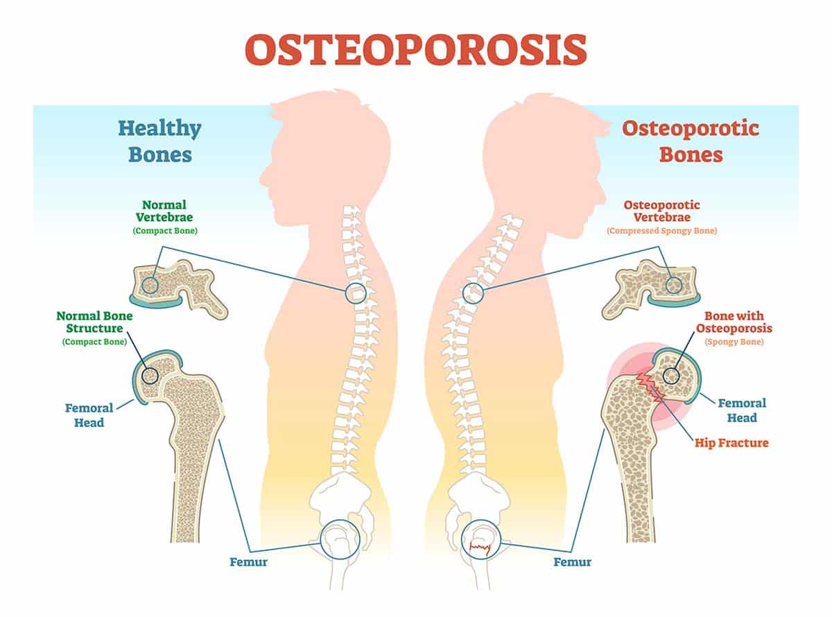 Comparison of healthy bones and osteoporotic bones, explaining the importance of bone density tests